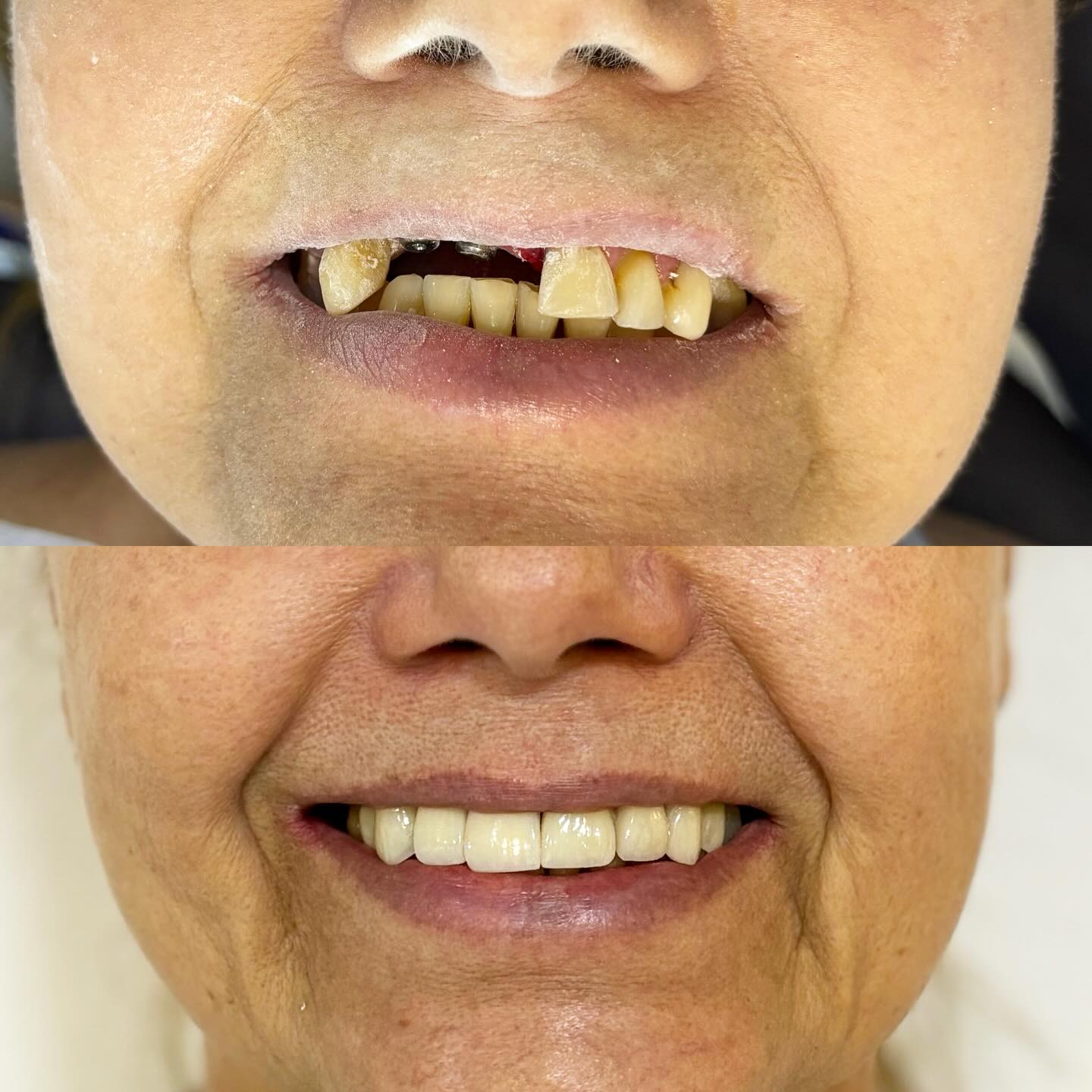 Lentes de Contato — antes e depois
